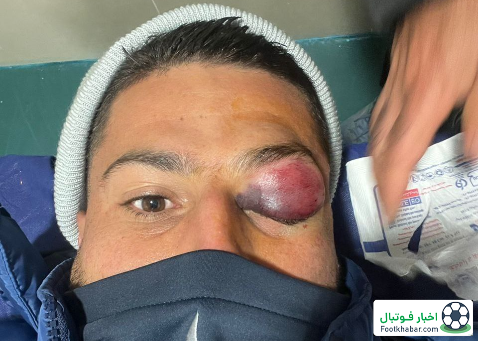 وضعیت وحشتناک چشم مدافع استقلال (عکس)